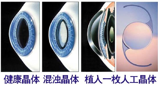 超聲乳化手術(shù)白內(nèi)障危險嗎？