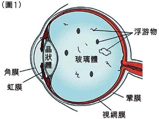 眼前有黑點(diǎn)飄，視物有些變形是什么眼病